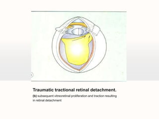 Traumatic tractional retinal detachment.(b) subsequent vitreoretinal proliferation and traction resultingin retinal detachment