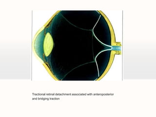 Tractional retinal detachment associated with anteroposteriorand bridging traction