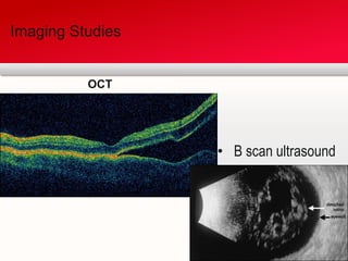 Imaging StudiesOCT B scan ultrasound
