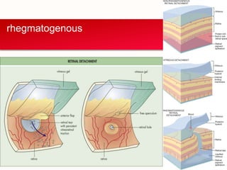 rhegmatogenous