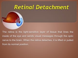 The retina is the light-sensitive layer of tissue that lines the
inside of the eye and sends visual messages through the optic
nerve to the brain. When the retina detaches, it is lifted or pulled
from its normal position.
 