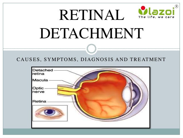 symptoms of detached retina symptoms of detached retina