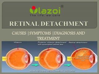 CAUSES |SYMPTOMS |DIAGNOSIS AND
TREATMENT
 