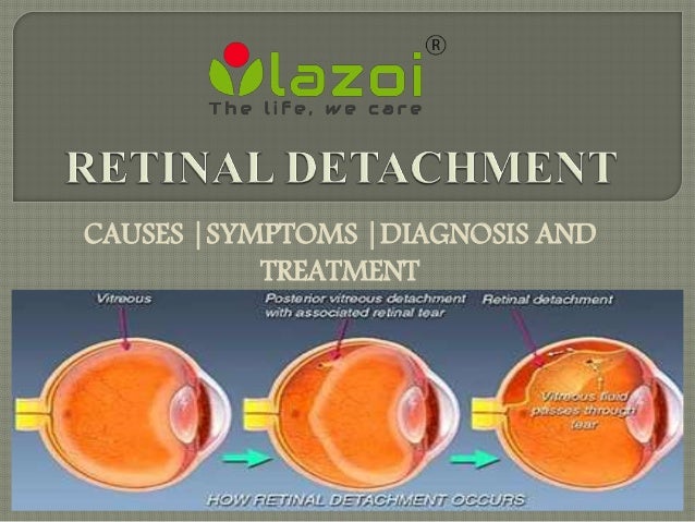 Retinal detachment : Causes, symptoms and treatment