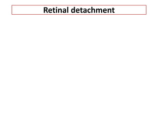 Retinal detachment
 