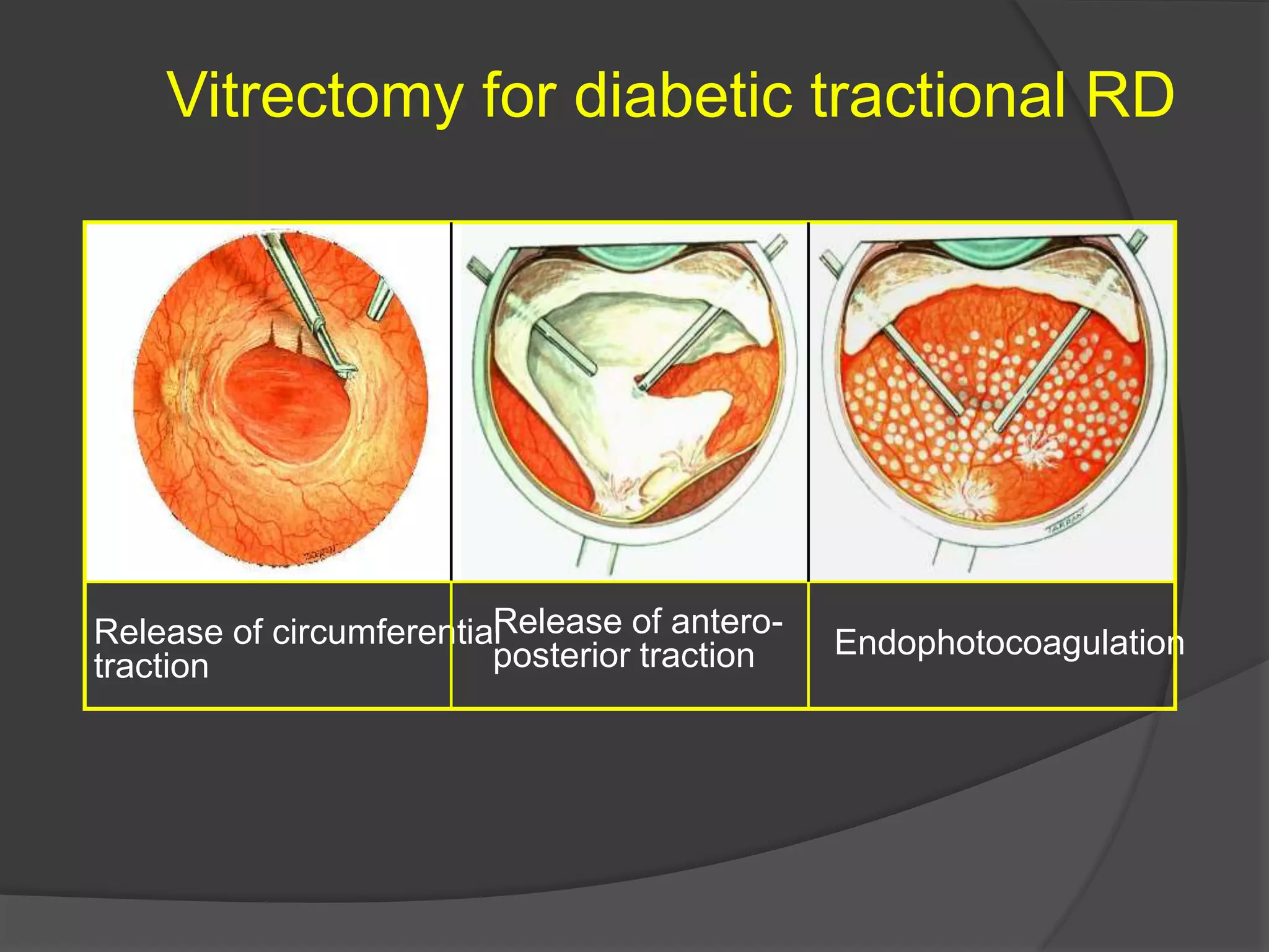Mild Tractional Rd RHEGMATOGENOUS Retinal detachment | PPTX