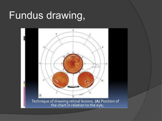RHEGMATOGENOUS Retinal detachment | PPTX