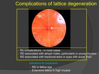 RHEGMATOGENOUS Retinal detachment | PPTX