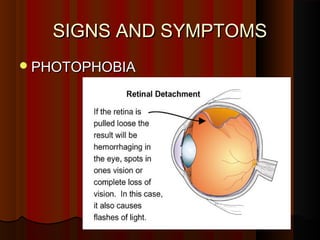 SIGNS AND SYMPTOMSSIGNS AND SYMPTOMS
PHOTOPHOBIAPHOTOPHOBIA
 