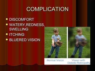 COMPLICATIONCOMPLICATION
 DISCOMFORTDISCOMFORT
 WATERY,REDNESS,WATERY,REDNESS,
SWELLINGSWELLING
 ITCHINGITCHING
 BLUERED VISIONBLUERED VISION
 