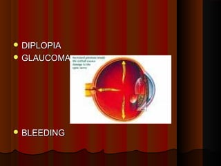  DIPLOPIADIPLOPIA
 GLAUCOMAGLAUCOMA
 BLEEDINGBLEEDING
 