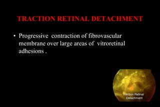 Retinal detachment | PDF