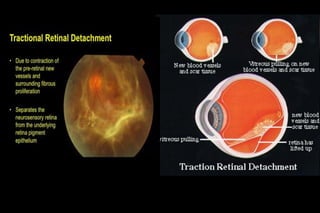 Retinal detachment | PDF