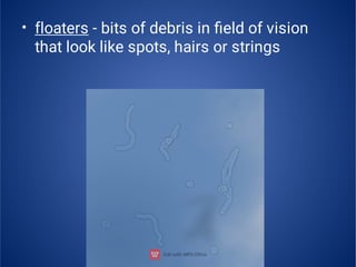 • floaters - bits of debris in ﬁeld of vision
that look like spots, hairs or strings
 