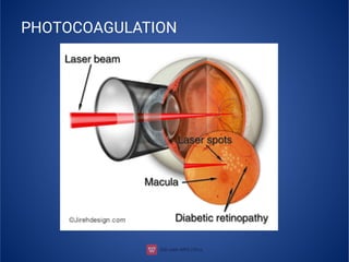 PHOTOCOAGULATION
 