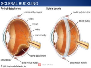 SCLERAL BUCKLING
 