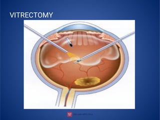VITRECTOMY
 
