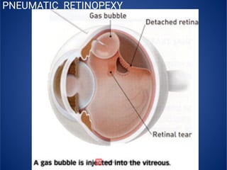 PNEUMATIC RETINOPEXY
 