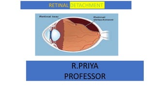 R.PRIYA
PROFESSOR
RETINAL DETACHMENT
 