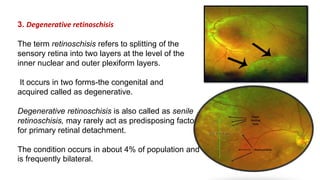 Retinal Splitting Retinal detachment | PPTX