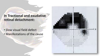 • Slow visual field defect
• Manifestations of the cause
 