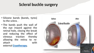 Retinal detachment | PPTX