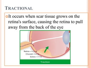 Mild Tractional Rd REtinal detachment.pptx