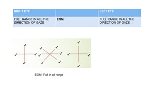 RIGHT EYE LEFT EYE
FULL RANGE IN ALL THE
DIRECTION OF GAZE
EOM FULL RANGE IN ALL THE
DIRECTION OF GAZE
EOM- Full in all range
 