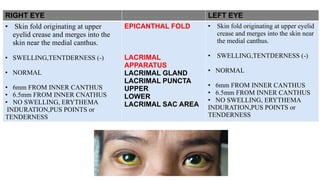 RIGHT EYE LEFT EYE
• Skin fold originating at upper
eyelid crease and merges into the
skin near the medial canthus.
• SWELLING,TENTDERNESS (-)
• NORMAL
• 6mm FROM INNER CANTHUS
• 6.5mm FROM INNER CNATHUS
• NO SWELLING, ERYTHEMA
INDURATION,PUS POINTS or
TENDERNESS
EPICANTHAL FOLD
LACRIMAL
APPARATUS
LACRIMAL GLAND
LACRIMAL PUNCTA
UPPER
LOWER
LACRIMAL SAC AREA
• Skin fold originating at upper eyelid
crease and merges into the skin near
the medial canthus.
• SWELLING,TENTDERNESS (-)
• NORMAL
• 6mm FROM INNER CANTHUS
• 6.5mm FROM INNER CANTHUS
• NO SWELLING, ERYTHEMA
INDURATION,PUS POINTS or
TENDERNESS
 
