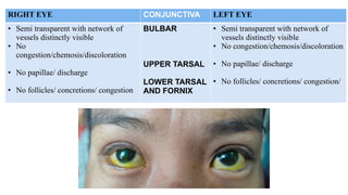 RIGHT EYE CONJUNCTIVA LEFT EYE
• Semi transparent with network of
vessels distinctly visible
• No
congestion/chemosis/discoloration
• No papillae/ discharge
• No follicles/ concretions/ congestion
BULBAR
UPPER TARSAL
LOWER TARSAL
AND FORNIX
• Semi transparent with network of
vessels distinctly visible
• No congestion/chemosis/discoloration
• No papillae/ discharge
• No follicles/ concretions/ congestion/
 