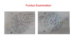 Fundus Examination
 