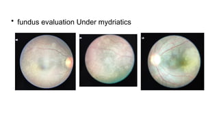 • fundus evaluation Under mydriatics
 