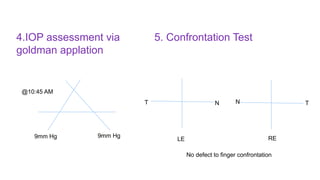 No defect to finger confrontation
4.IOP assessment via
goldman applation
9mm Hg 9mm Hg
@10:45 AM
5. Confrontation Test
LE RE
T N
N T
 