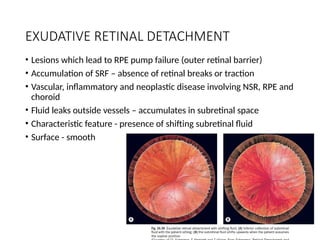 RETINAL DETACHMENT.pptxRetinal detachment is the separation of the ...
