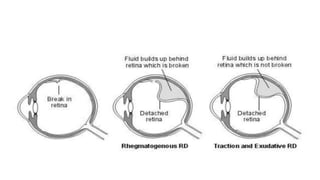RETINAL DETACHMENT - final.pptx