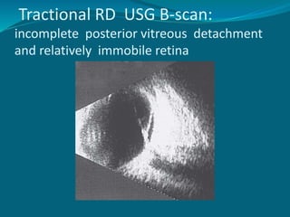 Mild Tractional Rd Retinal detachment | PPTX