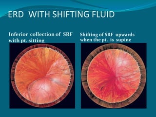 ERD WITH SHIFTING FLUID
Inferior collection of SRF
with pt. sitting
Shifting of SRF upwards
when the pt. is supine
 