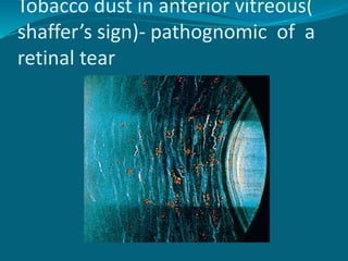 Retinal Detachment PPTX Retinal Detachment PPTX