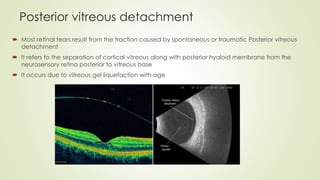 Posterior vitreous detachment
 Most retinal tears result from the traction caused by spontaneous or traumatic Posterior vitreous
detachment
 It refers to the separation of cortical vitreous along with posterior hyaloid membrane from the
neurosensory retina posterior to vitreous base
 It occurs due to vitreous gel liquefaction with age
 