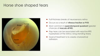 Horse shoe shaped tears
 Full thickness breaks of neurosensory retina
 Occurs as a result of vitreous traction or PVD
 Most common in superotemporal quadrant (greater
chances of macula off RD)
 Flap tears can be associated with reactive RPE
hyperplasia of the retina ( long standing tears)
 Goal of treatment is to create chorioretinal
adhesion.
Horns
Base
Apex
 