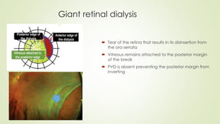 Giant retinal dialysis
 Tear of the retina that results in its disinsertion from
the ora serrata
 Vitreous remains attached to the posterior margin
of the break
 PVD is absent preventing the posterior margin from
inverting
 