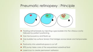 Pneumatic retinopexy : Principle
 Treating retinal breaks by injecting a gas bubble into the vitreous cavity
followed by patient positioning.
 Gas has buoyancy and floats up
 Gas bubble has surface tension that bridges across break and tamponades
it.
 Fluid entry into subretinal space is cut off
 RPE pump takes care of the sequestered subretinal fluid
 Laser/cryo to create permanent adhesion
 