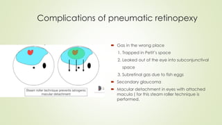 Complications of pneumatic retinopexy
 Gas in the wrong place
1. Trapped in Petit’s space
2. Leaked out of the eye into subconjunctival
space
3. Subretinal gas due to fish eggs
 Secondary glaucoma
 Macular detachment in eyes with attached
macula ( for this steam roller technique is
performed.
 