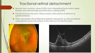 Tractional retinal detachment
 Second most common cause of RD is from vitreoretinal forces which apply
traction and mechanically pull retina from underlying RPE
 Tractional forces may be in vitreous body, inner surface of retina or as
subretinal fibrosis
 Often associated with proliferative diabetic retinopathy as abnormal blood
vessel growth across the surface of the retina act as traction point.
 