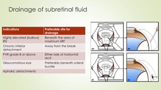 Drainage of subretinal fluid
Indications Preferable site for
drainage
Highly elevated (bullous)
RD
Beneath the area of
maximum SRF
Chronic inferior
detachment
Away from the break
PVR grade B or above Either side of horizontal
recti
Glaucomatous eye Preferably beneath scleral
buckle
Aphakic detachments
 