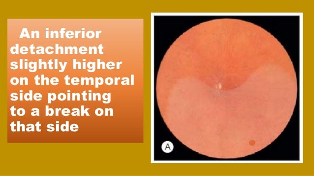 tractional retinal detachment
