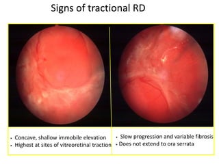 Mild Tractional Rd retinal_detachment 4.pptx
