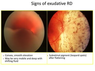 retinal_detachment 4.pptx