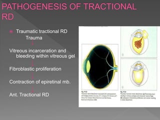 Mild Tractional Rd Retinal detachment | PPTX