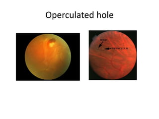DR WANI'S TALK ON RETINAL DETACHMENT LECTURE FOR RESIDENTS [DR WANI ...